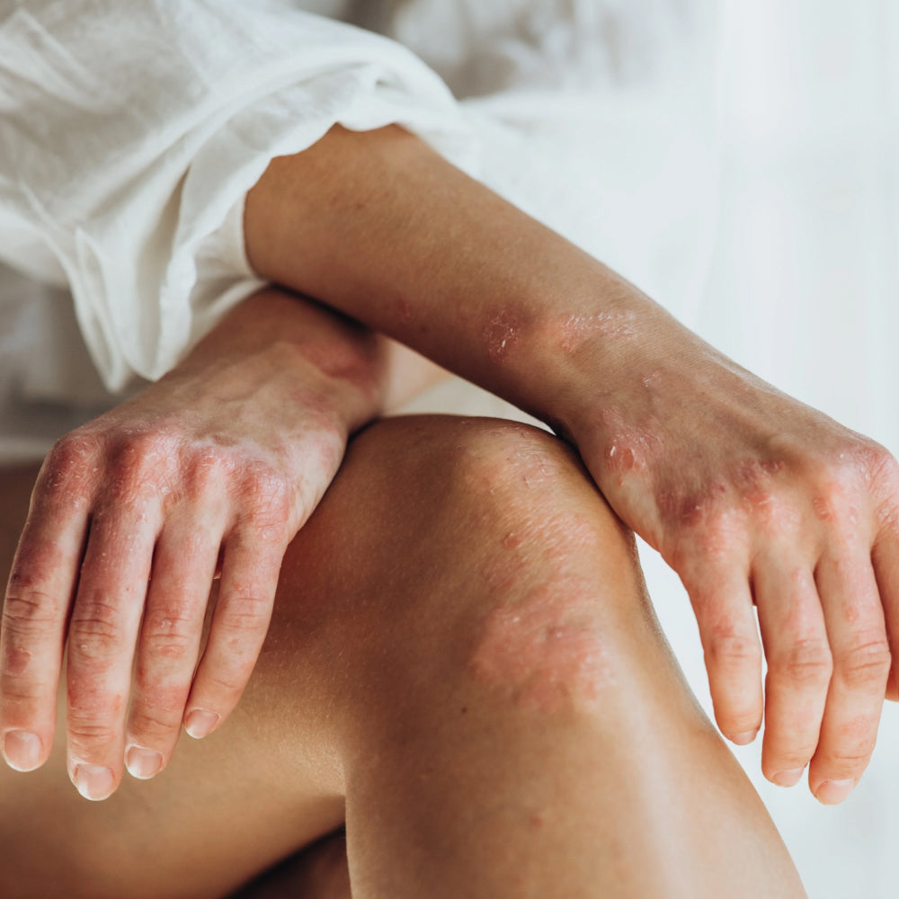 Are Eczema and Psoriasis Treated the Same Way? Key Differences