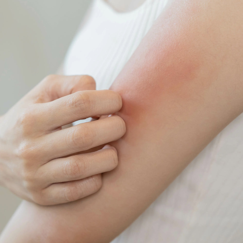 Choosing the Best Steroid Free Eczema Cream for You