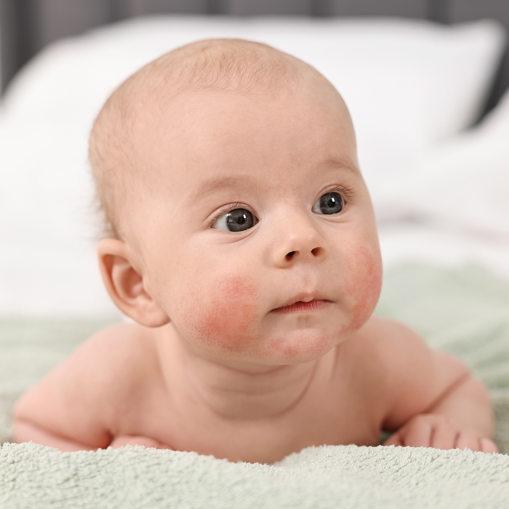 Best Eczema Cream for Kids: Safe and Effective Options