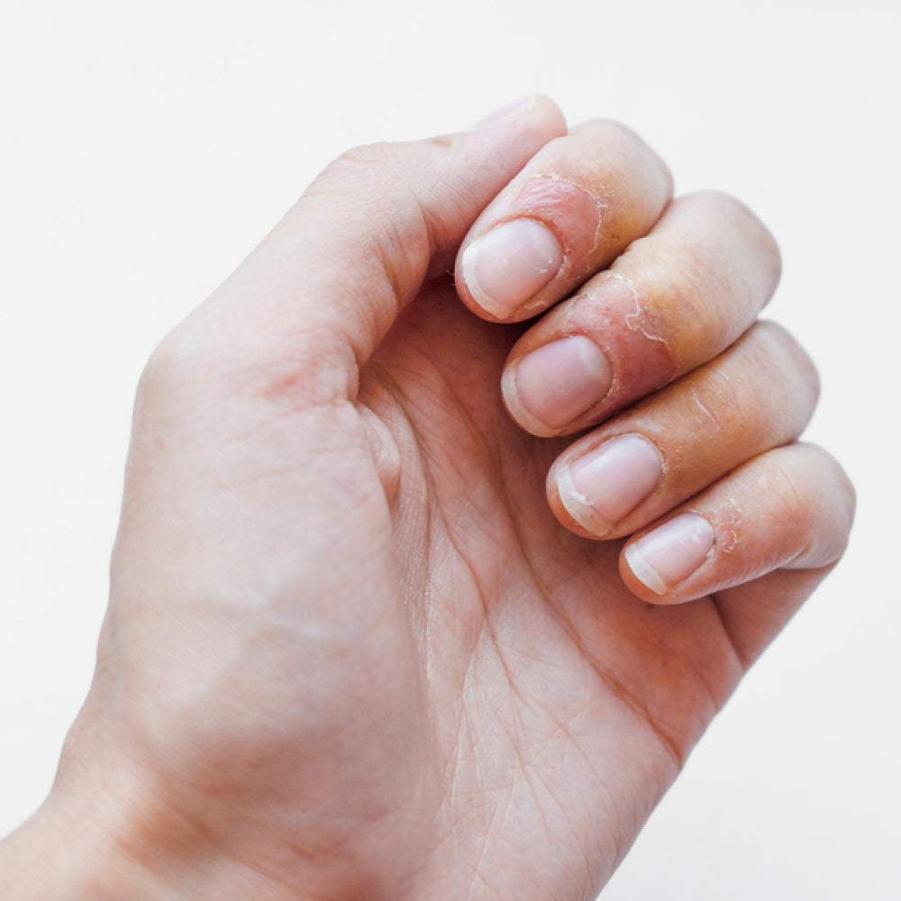 Nail Eczema vs Psoriasis: What You Should Know