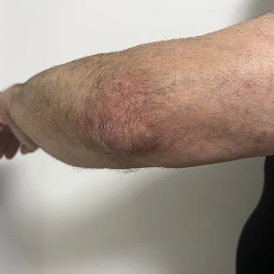 Customer photo, elbow, after