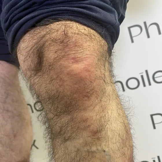 Customer photo, knee, after