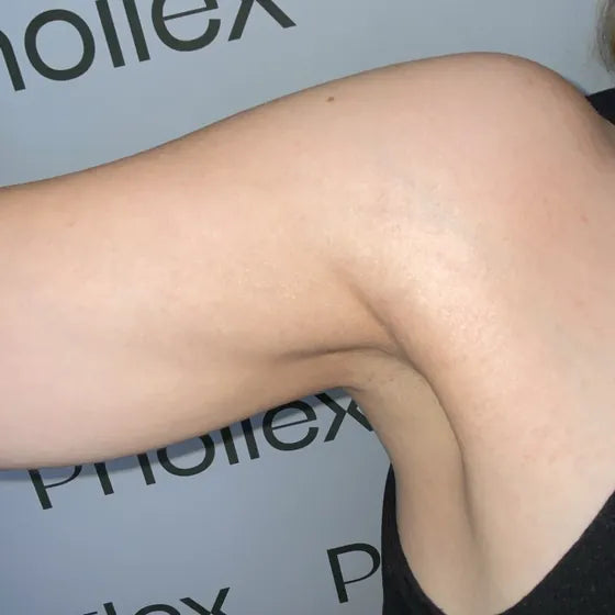 Customer photo, inner arm, after