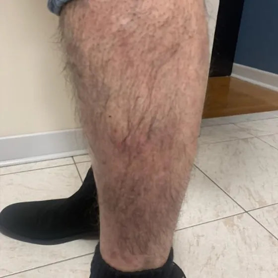 Customer photo, shin, after