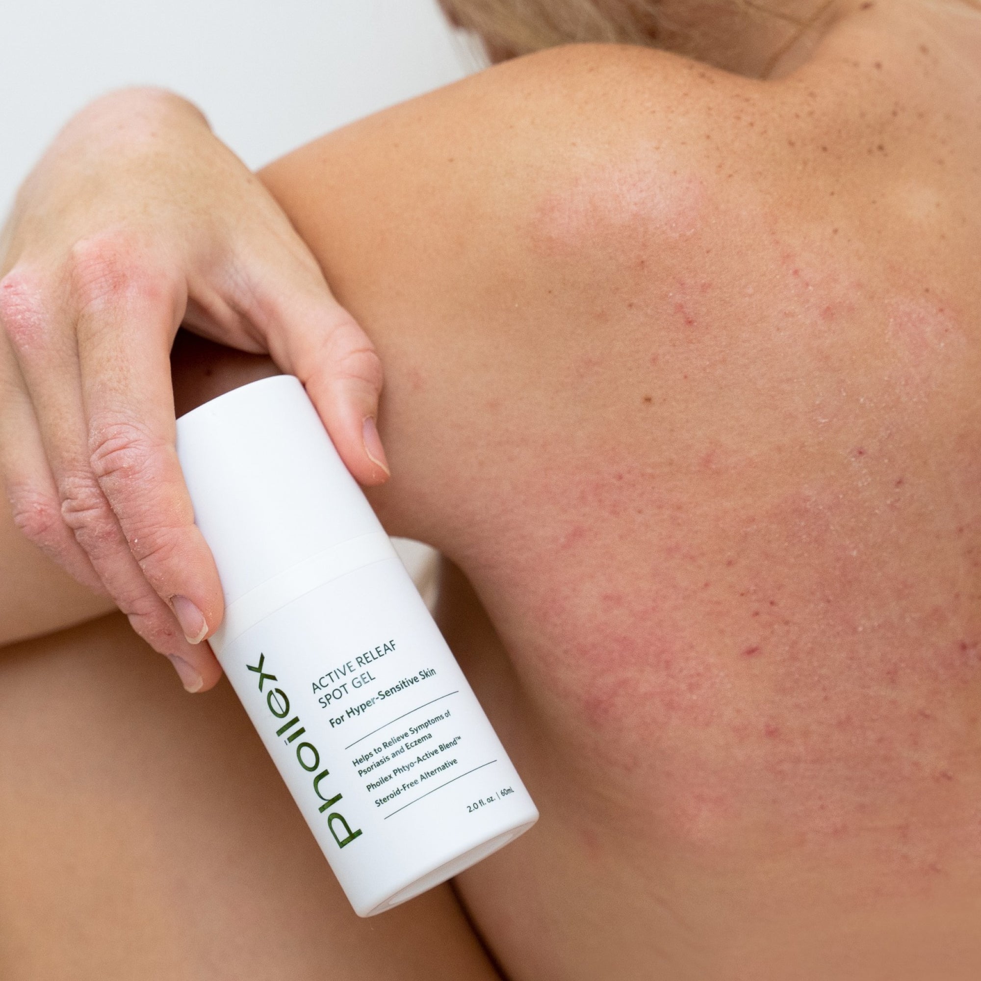 Why Eczema Gets Worse in Winter: The Real Triggers Behind Seasonal Flares