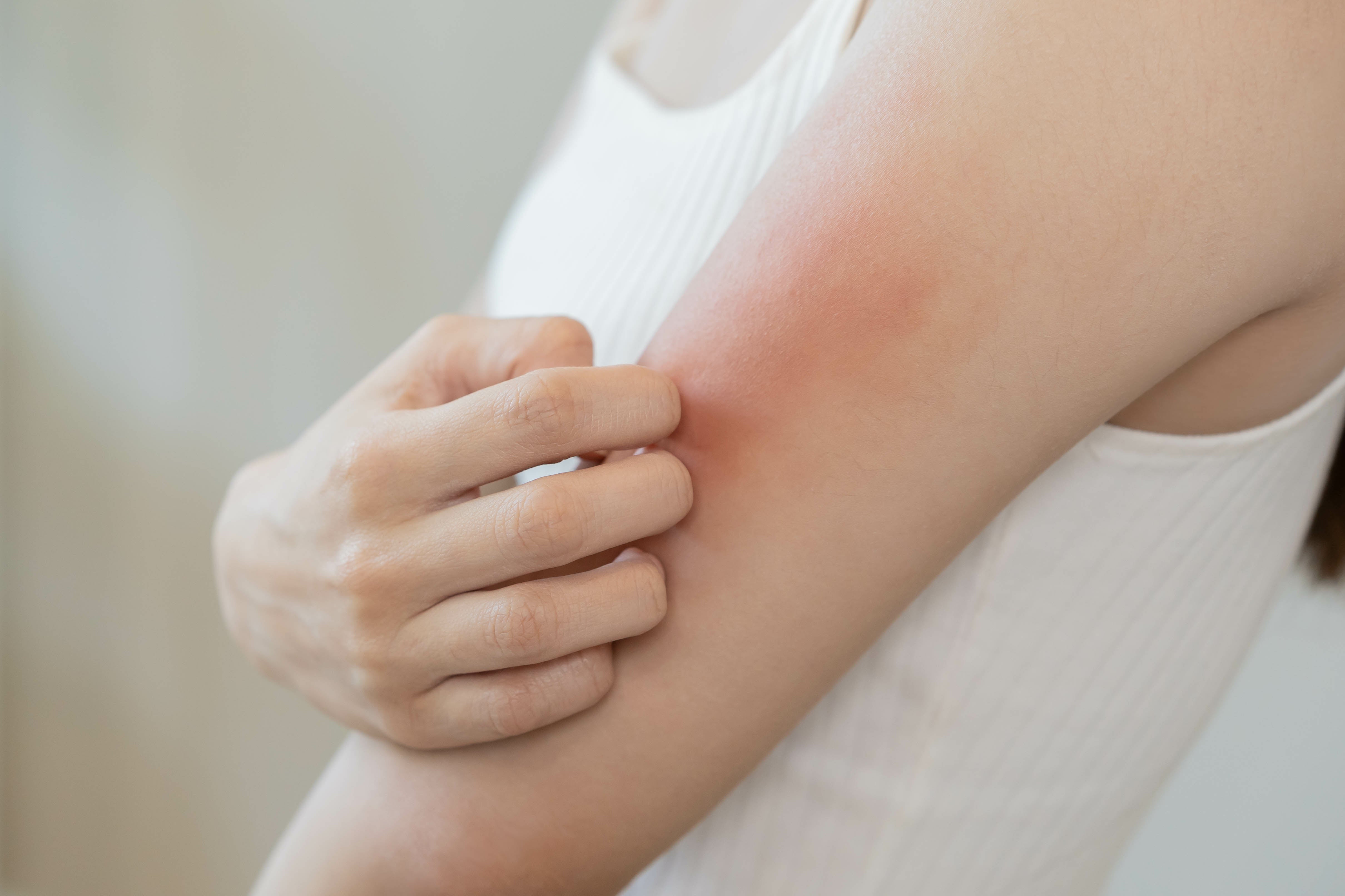 Choosing the Best Steroid Free Eczema Cream for You