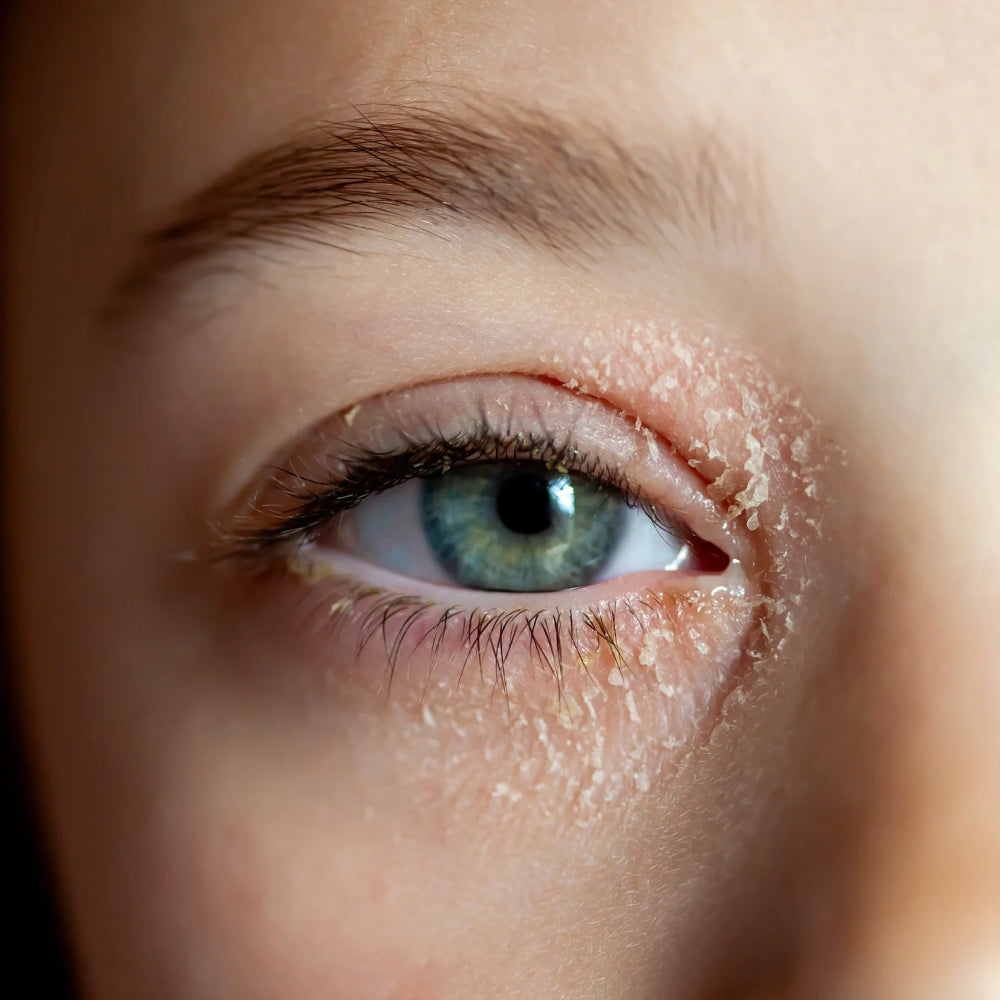 How to Treat Eczema Around the Eye: What You Need to Know