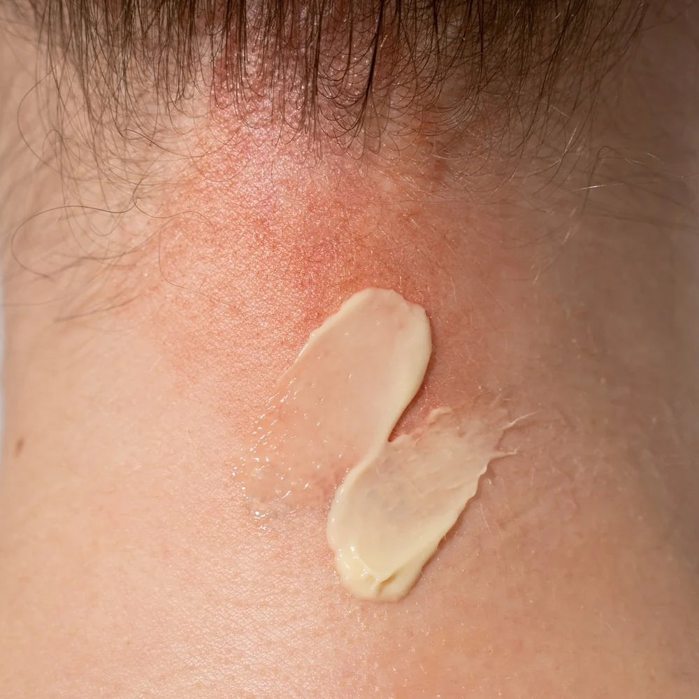 Key Differences Between Psoriasis And Eczema
