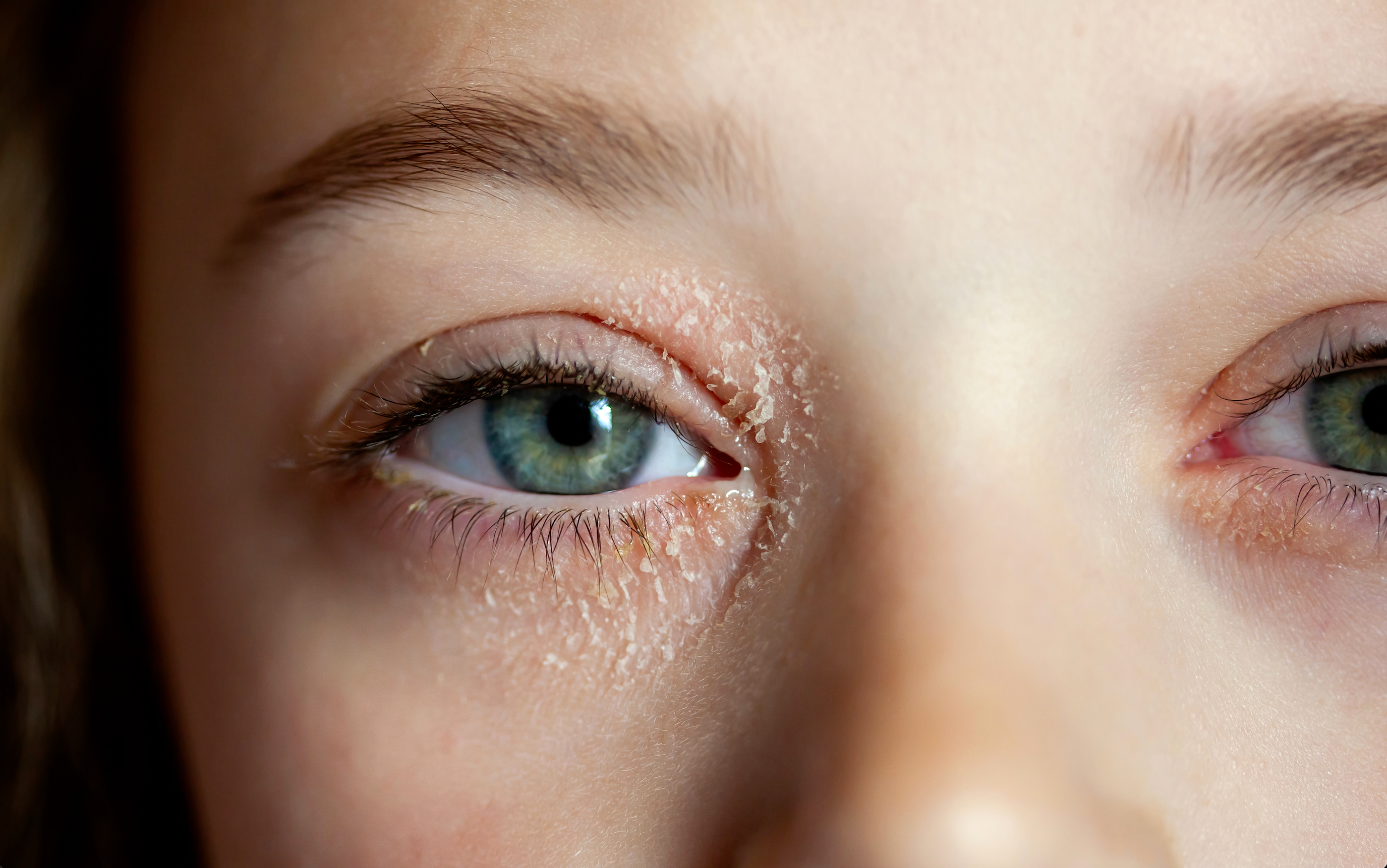 How to Treat Eczema Around the Eye: What You Need to Know