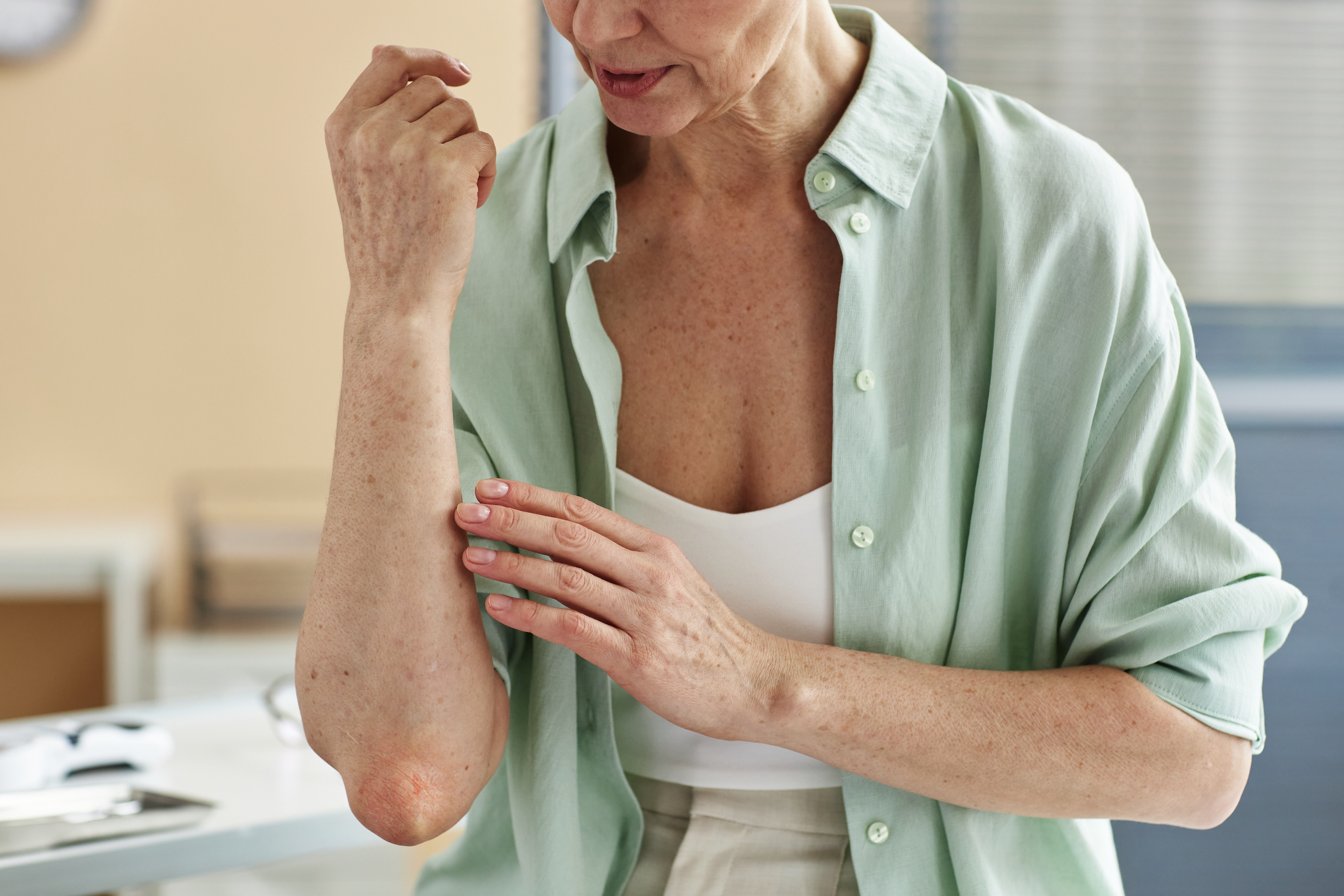 Eczema in Seniors: Causes, Symptoms, and Effective Treatments