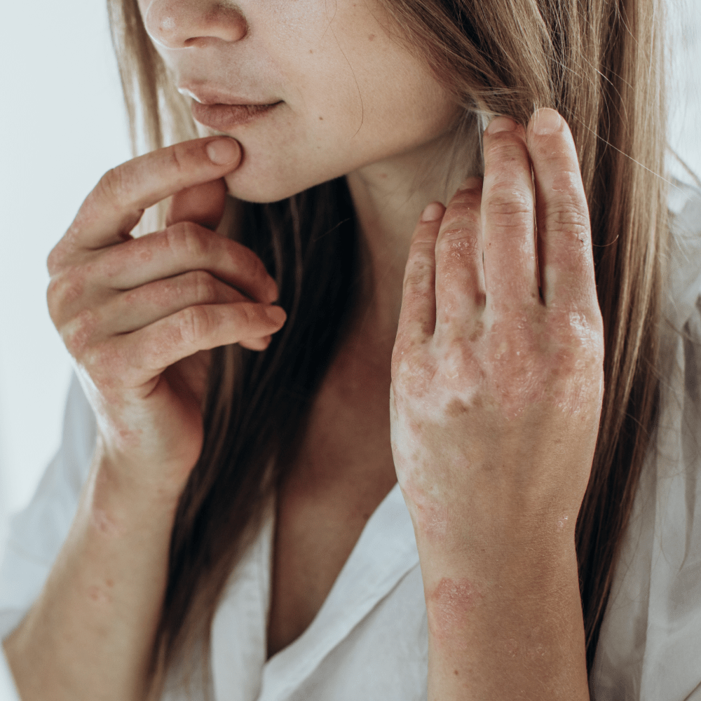 Best Face Eczema Products 2026: Gentle Formulas for Sensitive Facial Skin - Phoilex