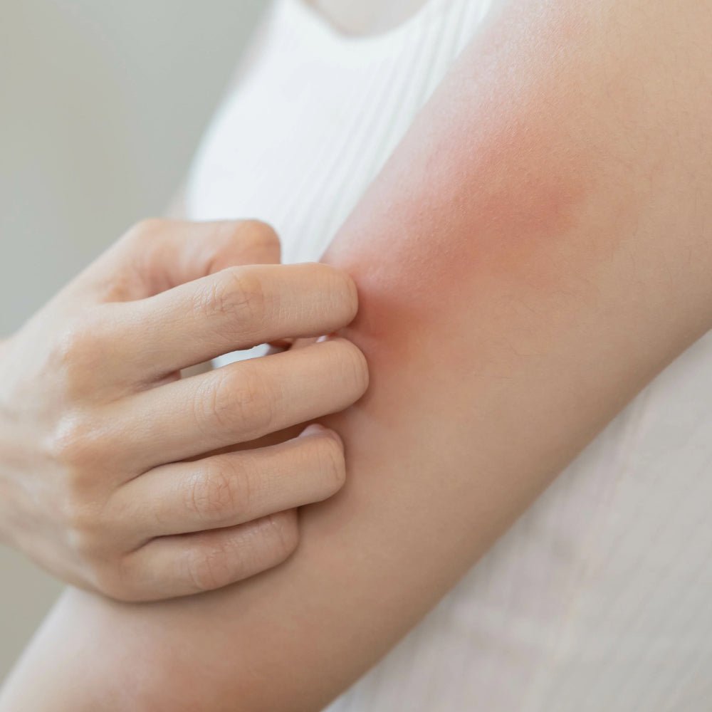 Choosing the Best Steroid Free Eczema Cream for You - Phoilex