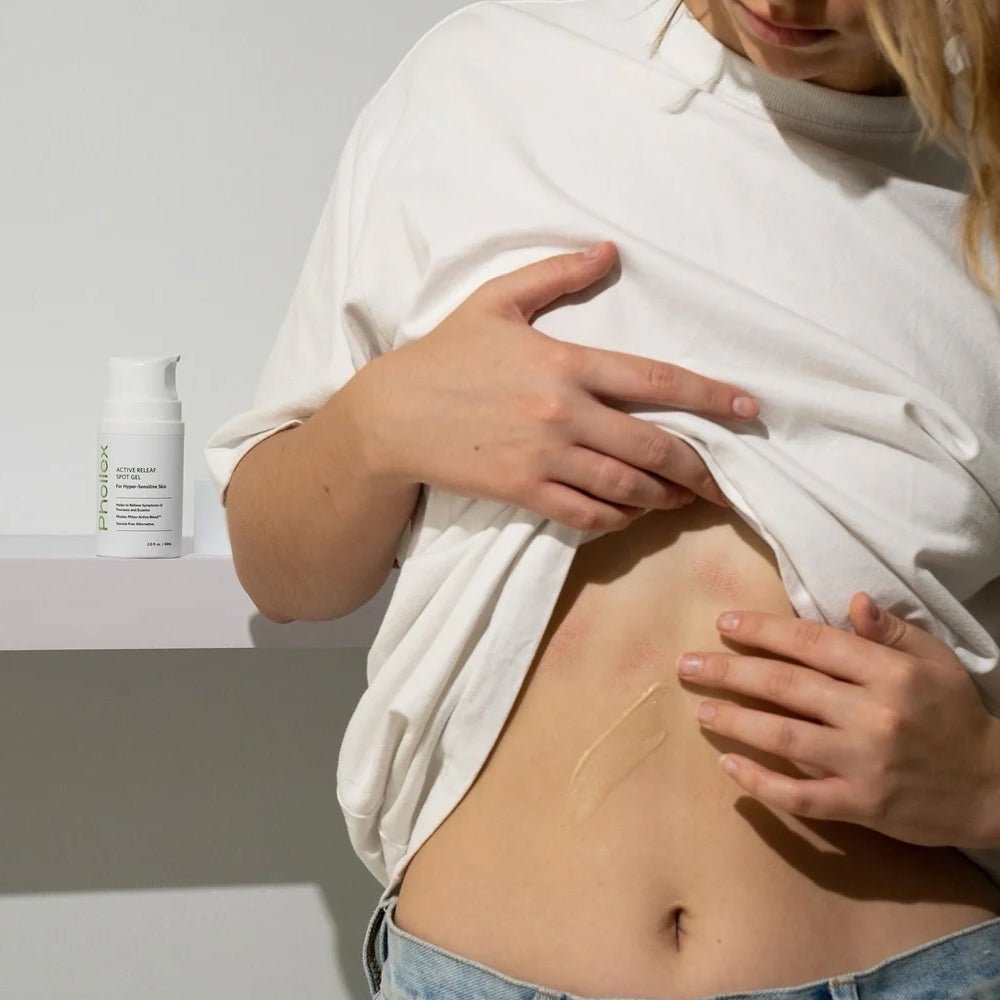 How to Treat Hormonal Eczema: Effective Tips and Solutions - Phoilex