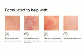 Formulated to help with eczema, psoriasis, rash-prone and post-steroid rebound-prone skin thumbnail