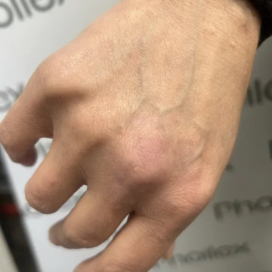 Customer photo, back of the hand, after