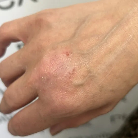 Customer photo, back of the hand, before