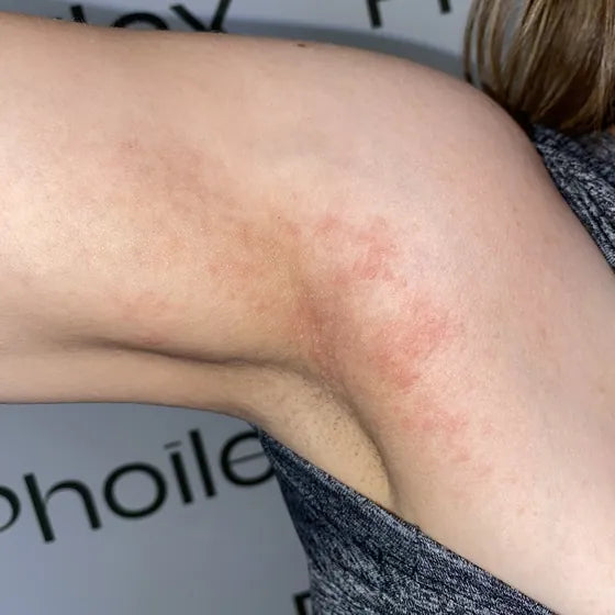 Customer photo, inner arm, before