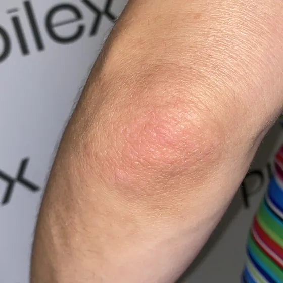 Customer photo, elbow, after