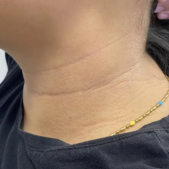 Customer photo, neck, after